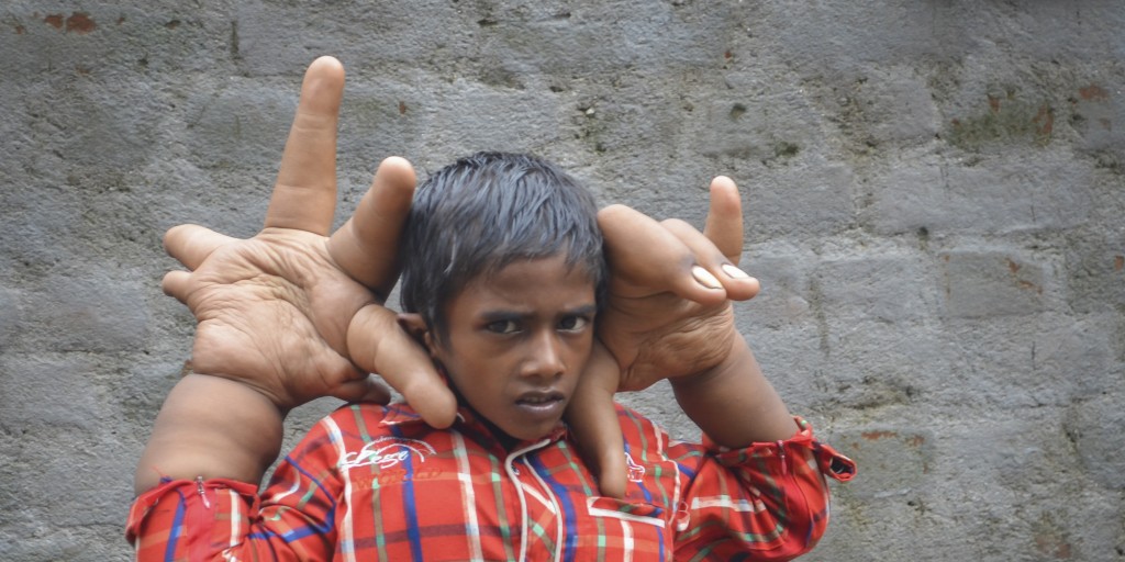 *** EXCLUSIVE - STRICT ONLINE ONLINE EMBARGO UNTIL 02:00 WEDNESDAY 20/08 *** EAST INDIA - JULY 2014: Eight-year-old Kaleem shows his abnormally large hands in his hometown, East India. A YOUNG boy is baffling doctors in India - after his hands swelled to giant proportions. Eight-year-old Kaleem's hands weigh eight kilograms each and measure 13 inches from the base of his palm to the end of his middle finger. The cricket fan is unable to do many basic tasks - including tying his shoes laces - and has been bullied and shunned most of his life. His parents, who live in eastern India, and earn just £15 a month, have been desperately trying to find help for their son but to no avail. Doctors have been left baffled by his condition but believe it may be the result of either lymphangioma or hamartoma - both treatable conditions. PHOTOGRAPH BY Barcroft India UK Office, London. T +44 845 370 2233 W www.barcroftmedia.com USA Office, New York City. T +1 212 796 2458 W www.barcroftusa.com Indian Office, Delhi. T +91 11 4053 2429 W www.barcroftindia.com