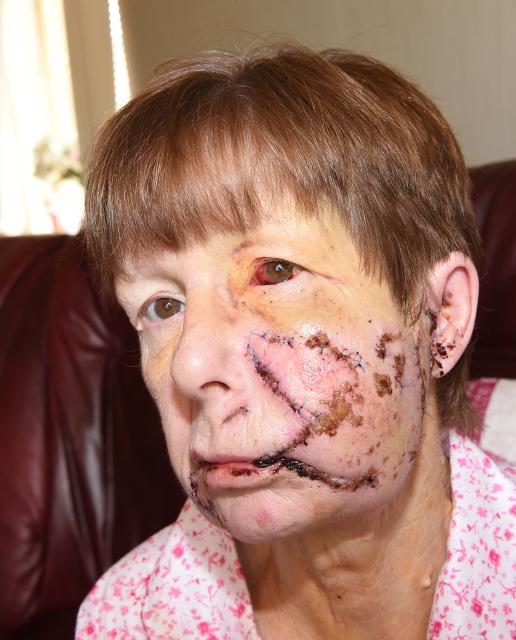 Pictured Sylvia Baillie aged 60 from Paisley who is now back home from hospital and is recovering after she was viciously attacked by a neighbour's Akita Japanese dog.She suffered horrific facial injuries during the attack which required many stitches. Copy Jennifer Hyland.Date 19/07/16.