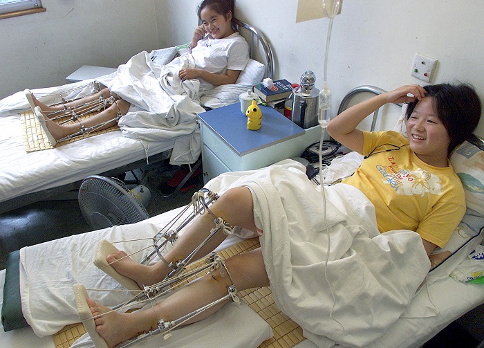 HANGZHOU, CHINA: Patients sit in their beds recovering after having operation to lengthen their legs at a hospital in China's eastern city of Hangzhou in Zhejiang province, 15 August 2002. The leg lengthening operation is beijing used just like plastic surgery, whereby people accept the risks in hope of becoming more confident after increasing their height. AFP PHOTO (Photo credit should read LIU JIN/AFP/Getty Images)