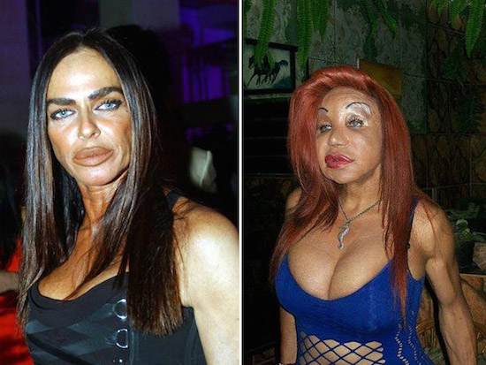plastic-surgery-gone-wrong-3
