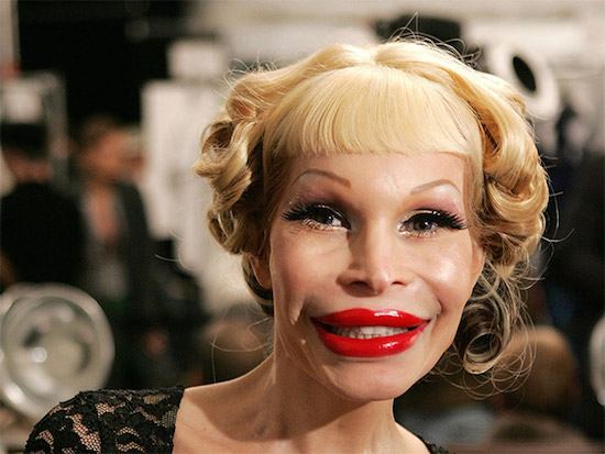 plastic-surgery-gone-wrong-12