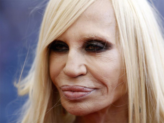 plastic-surgery-gone-wrong-15