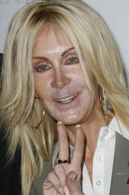 plastic-surgery-gone-wrong-17-445x670