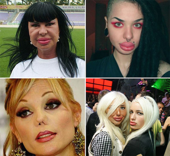 plastic-surgery-gone-wrong-7