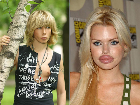 plastic-surgery-gone-wrong-9